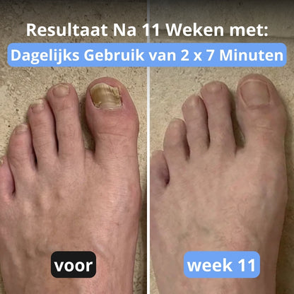 NoraClear™ - 3-in-1 therapie apparaat